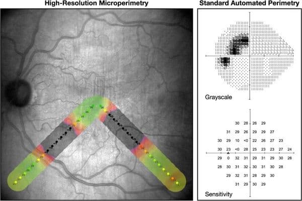 microperimetry glaucoma