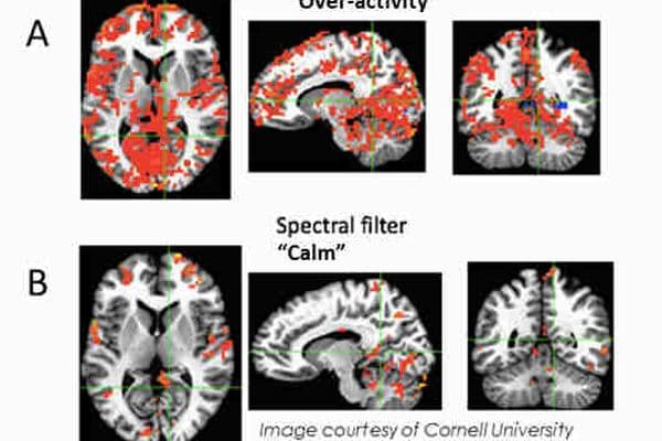 The Irlen Institute: the case for Irlen