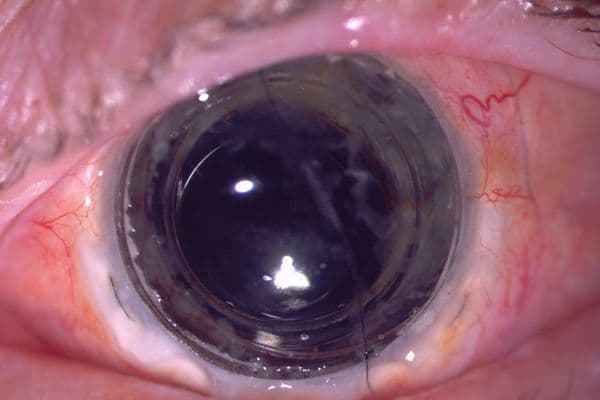 Artificial cornea restores vision in untransplantable eye