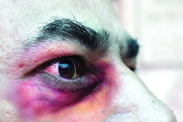 Covid spikes mucormycosis cases