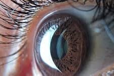 Free webinar: MBGS and corneal crosslinking