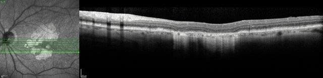 Established and emerging trends in AMD management-figure-2-oct-atrophy.jpg