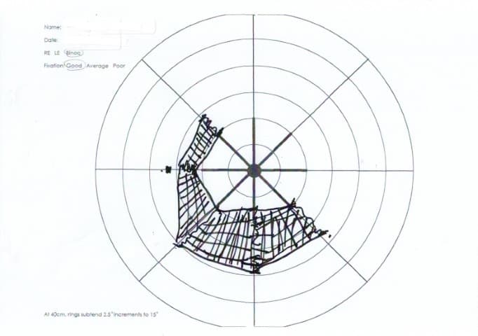 Glaucoma Fig 1