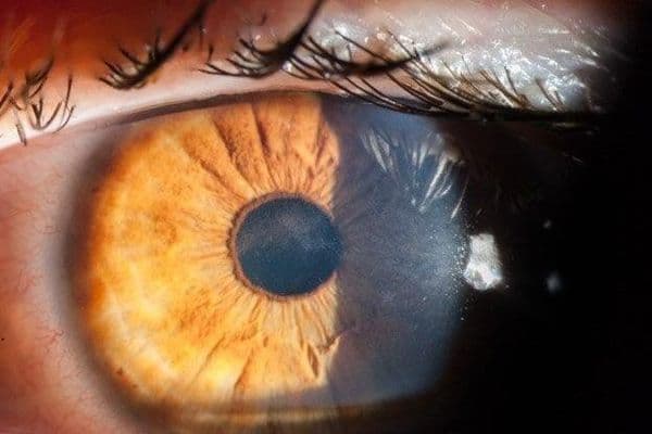 Conquering the diagnostic dilemma of Acanthamoeba keratitis