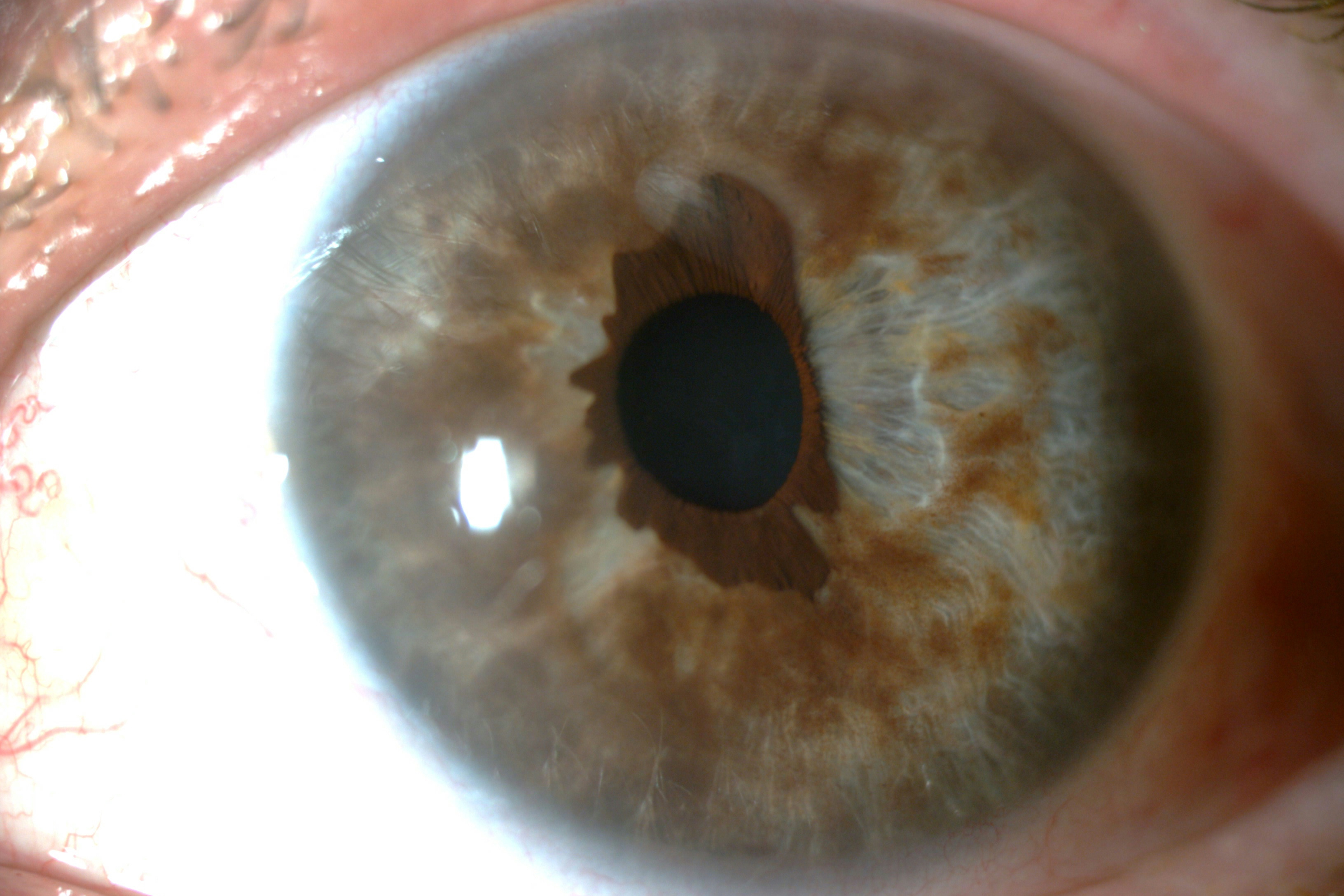 What Is Iris Melanoma