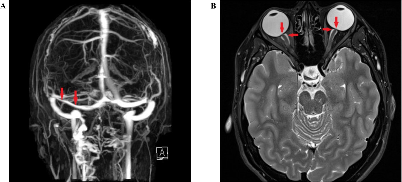 Idiopathic Intracranial Hypertension - Nzoptics