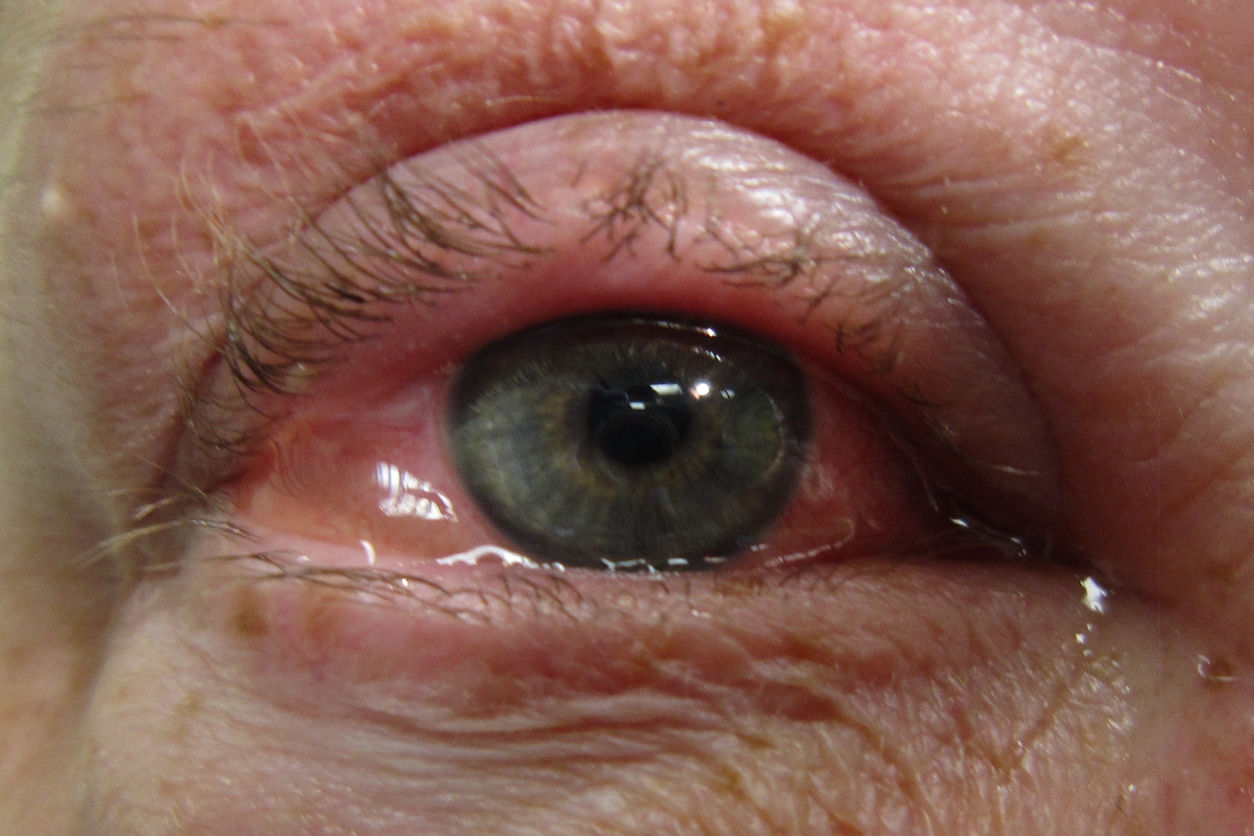 Can Allergies Cause Red Sore Eyes