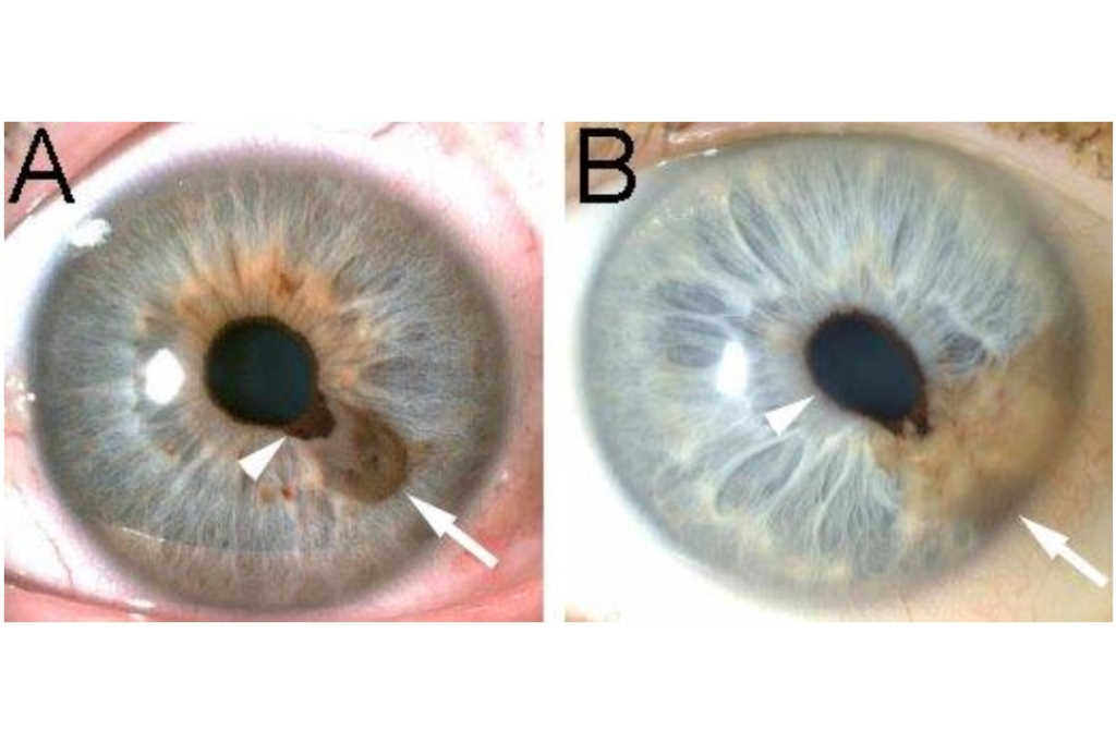 The iris in health and disease: part 1 - normal variations and