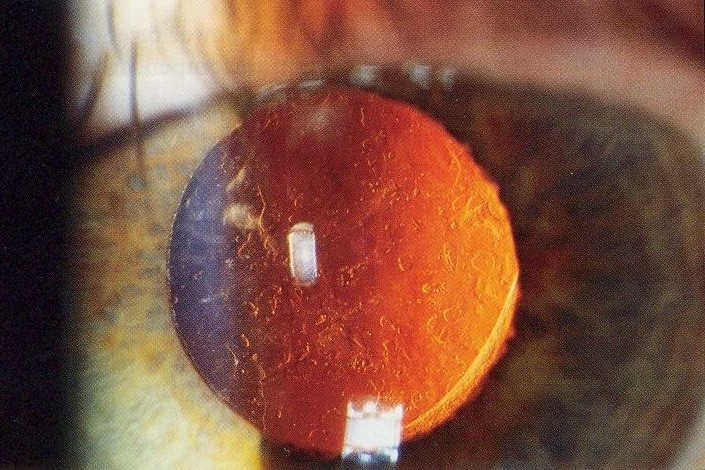 YAG laser for optoms proposed