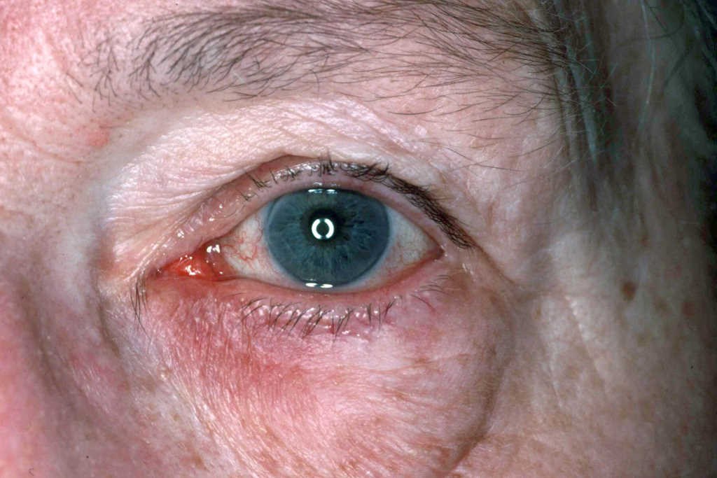 Oculoplastic labs, neoplasms and rosacea research