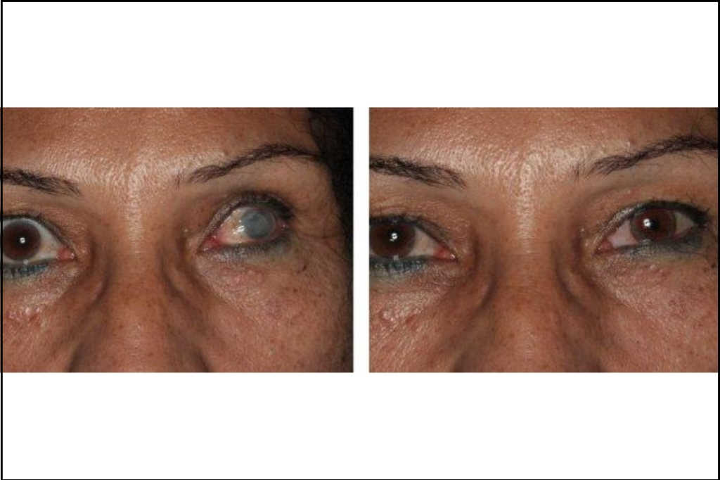 Calling all clinicians: Survey on ocular disfigurement