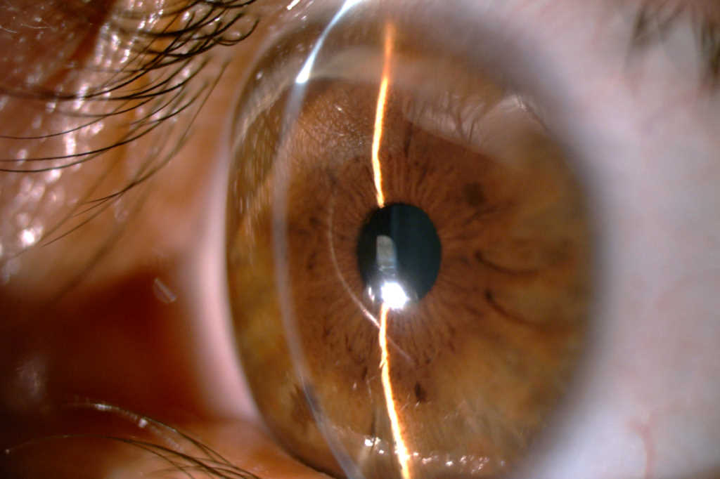A rare but profound cause of corneal thinning