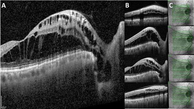 Optic Disc Pit With Maculopathy - Nzoptics